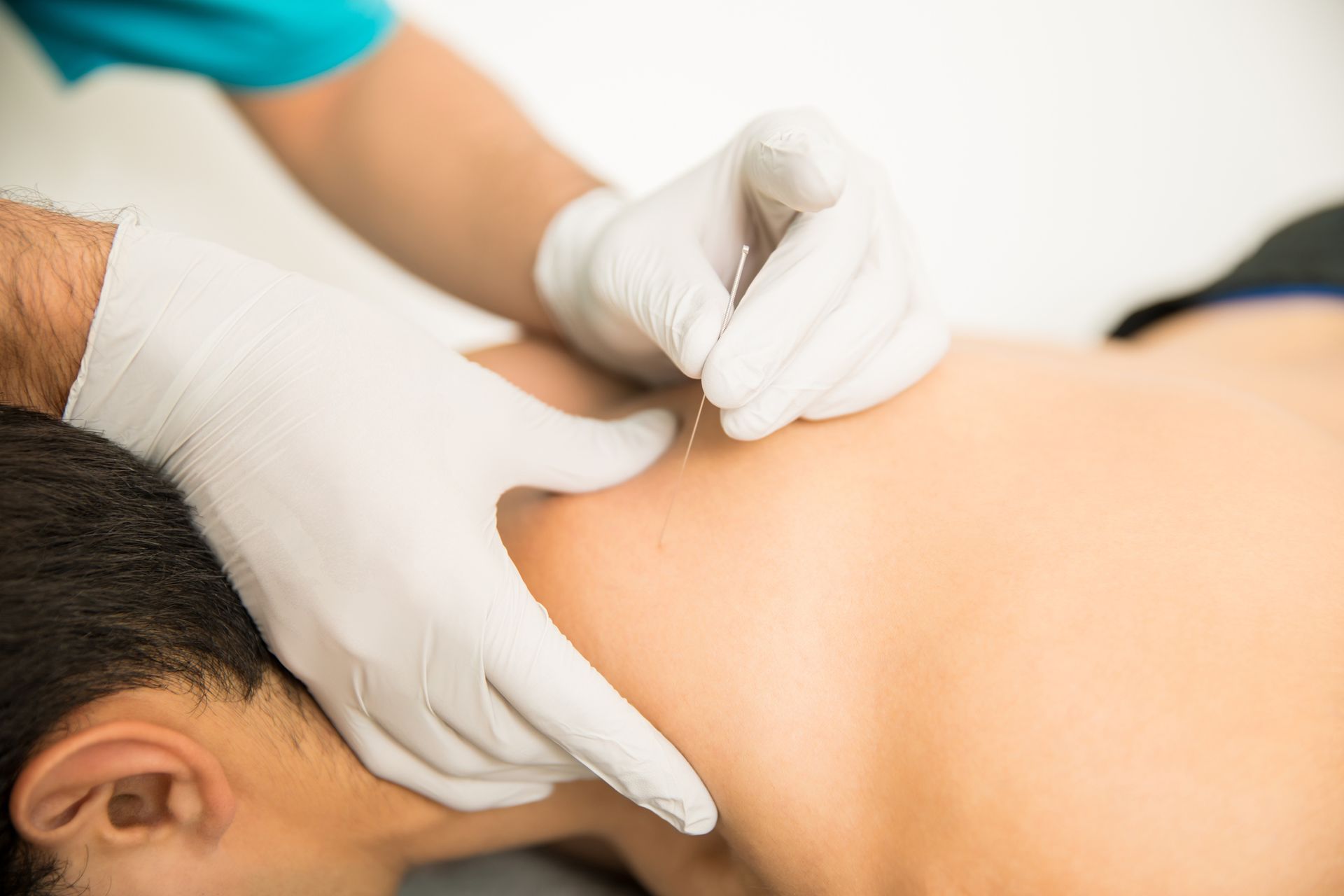 Dry Needling Therapy — Charlotte, NC — Greenapple Sports & Wellness
