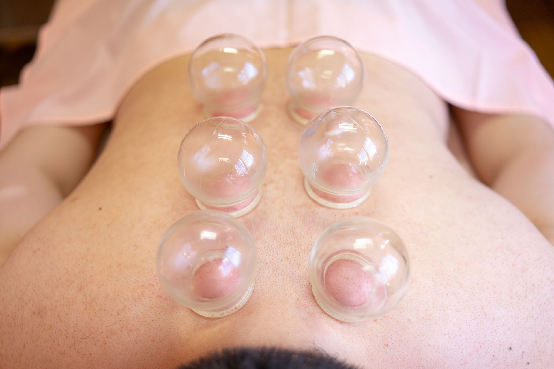 Woman Having a Cupping Therapy — Charlotte, NC  — Greenapple Sports & Wellness