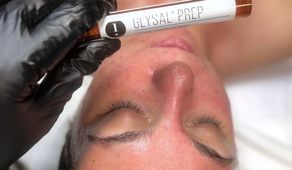 A woman is getting a facial treatment with a bottle of glysal prep.