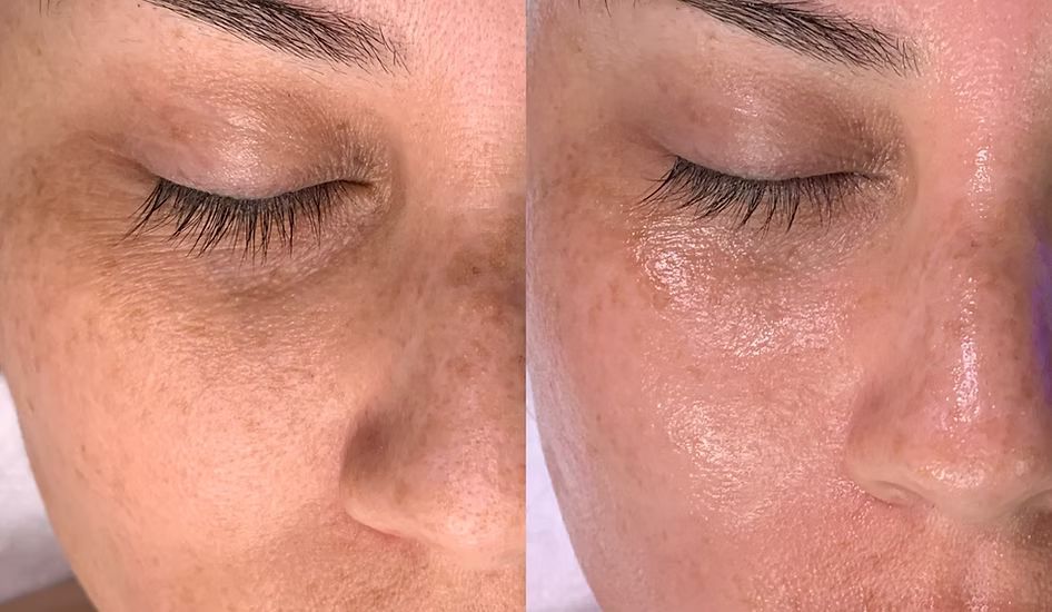 A before and after photo of a woman 's face.