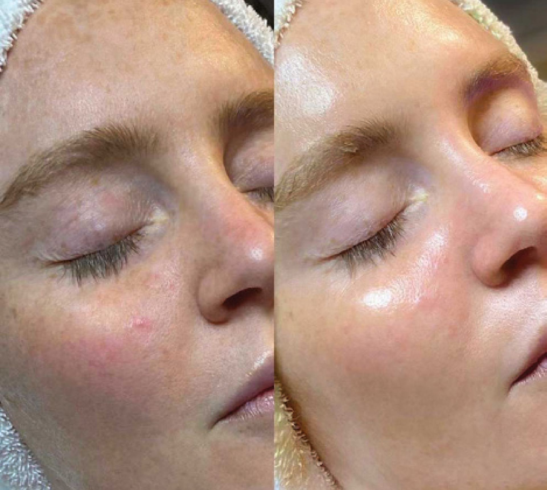 A before and after picture of a woman 's face with her eyes closed