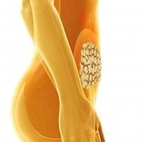 Ein computergeneriertes Bild vom Bauch einer Frau mit einem Knoten darin.