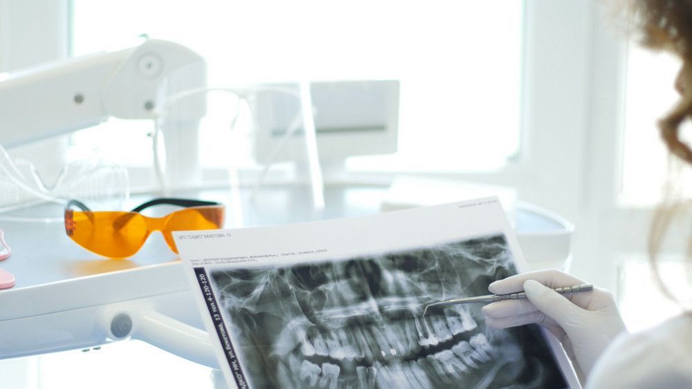 dental implants