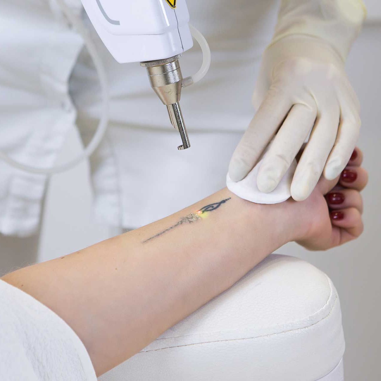 Cosmetologist doing laser tattoo removal from woman hand in cosmetology clinic
