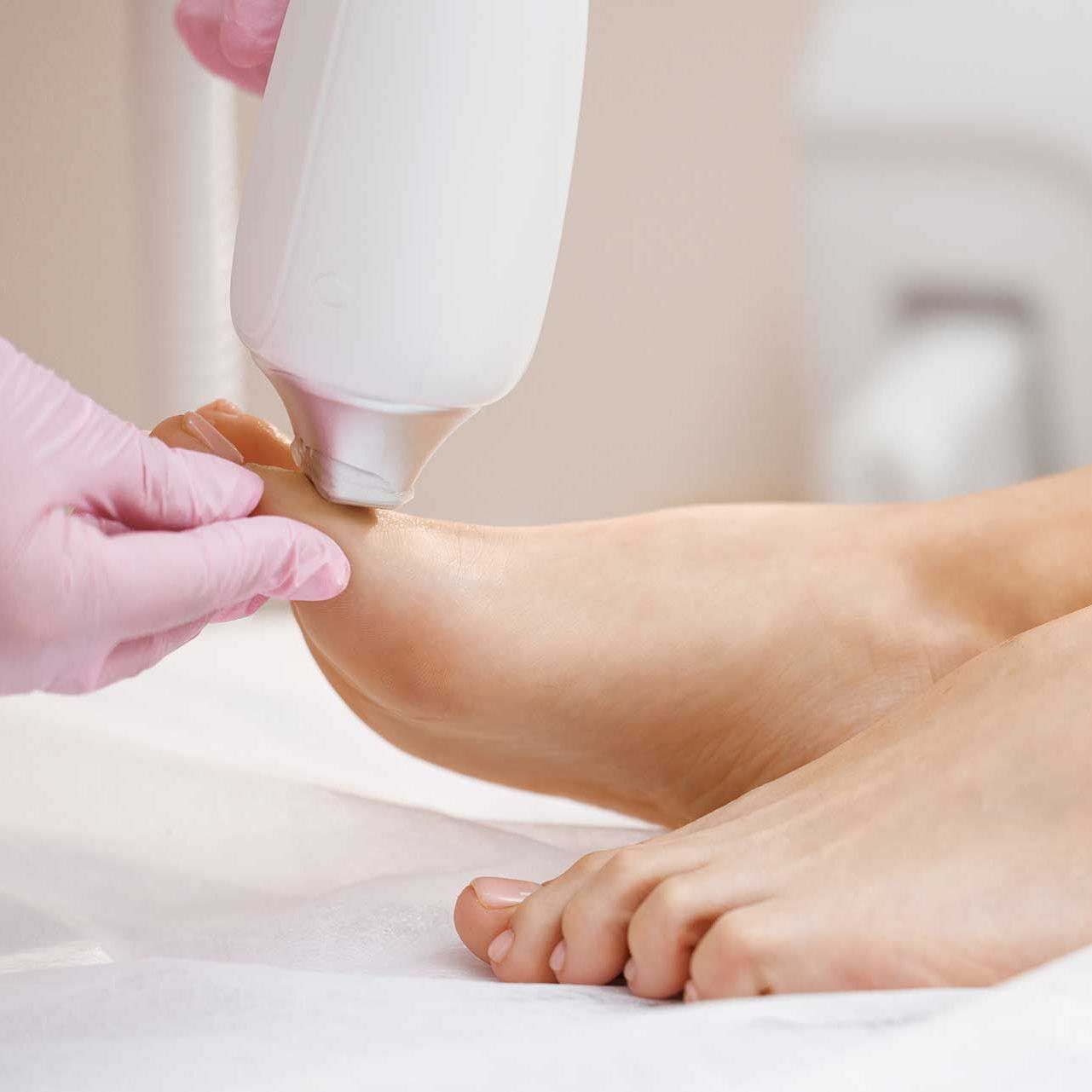 The doctor makes the procedure for the treatment of foot fungus.