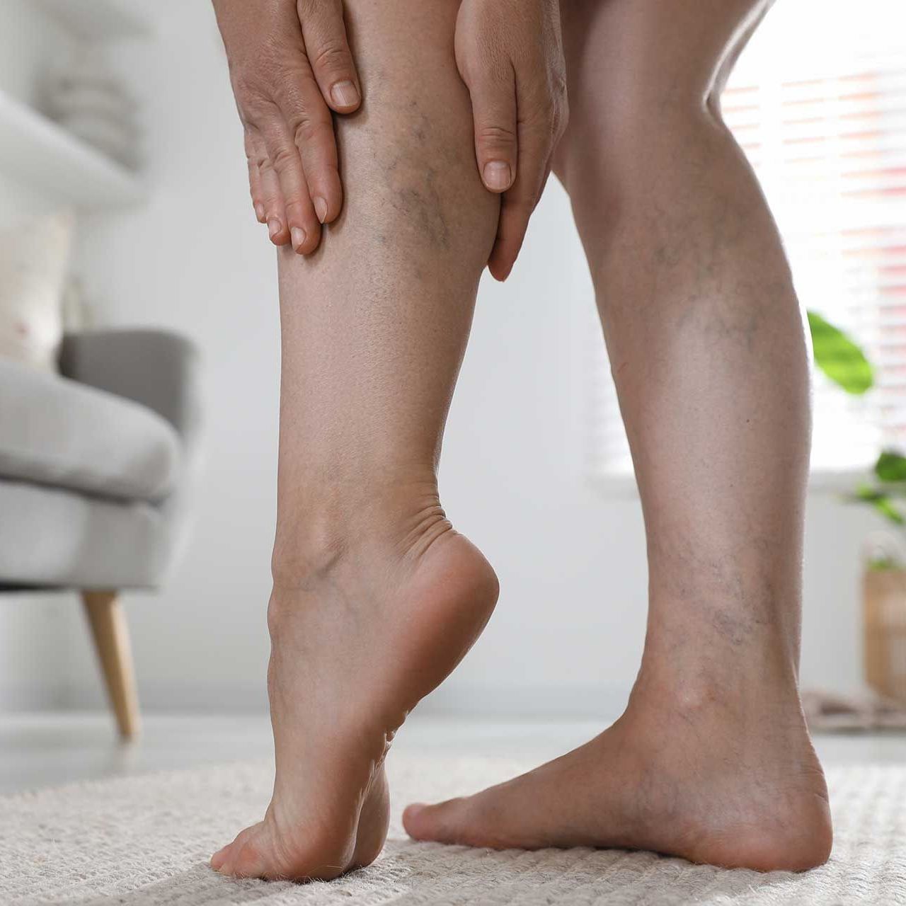 Woman suffering from varicose veins indoors