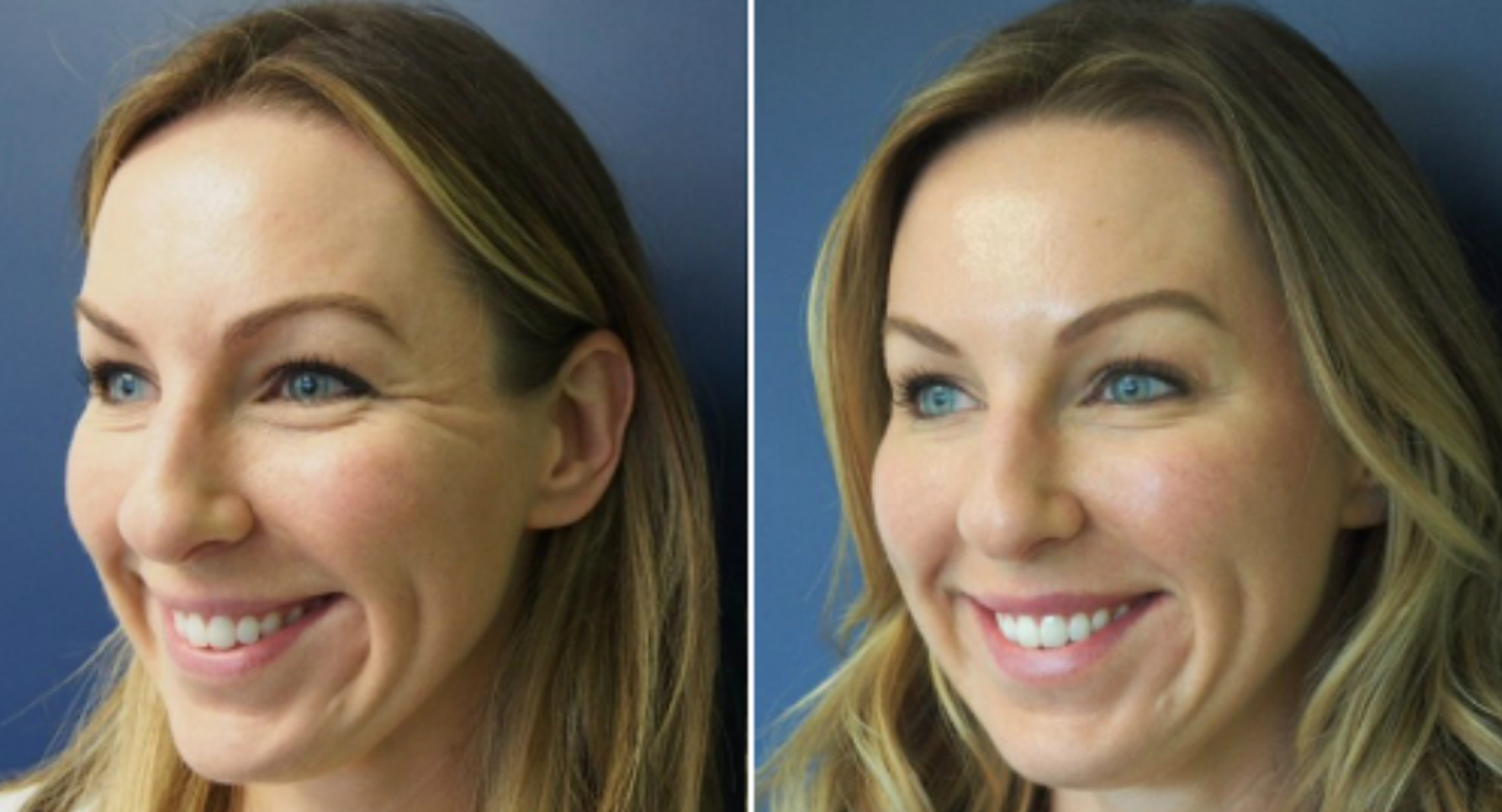 Agnes RF for Crows Feet