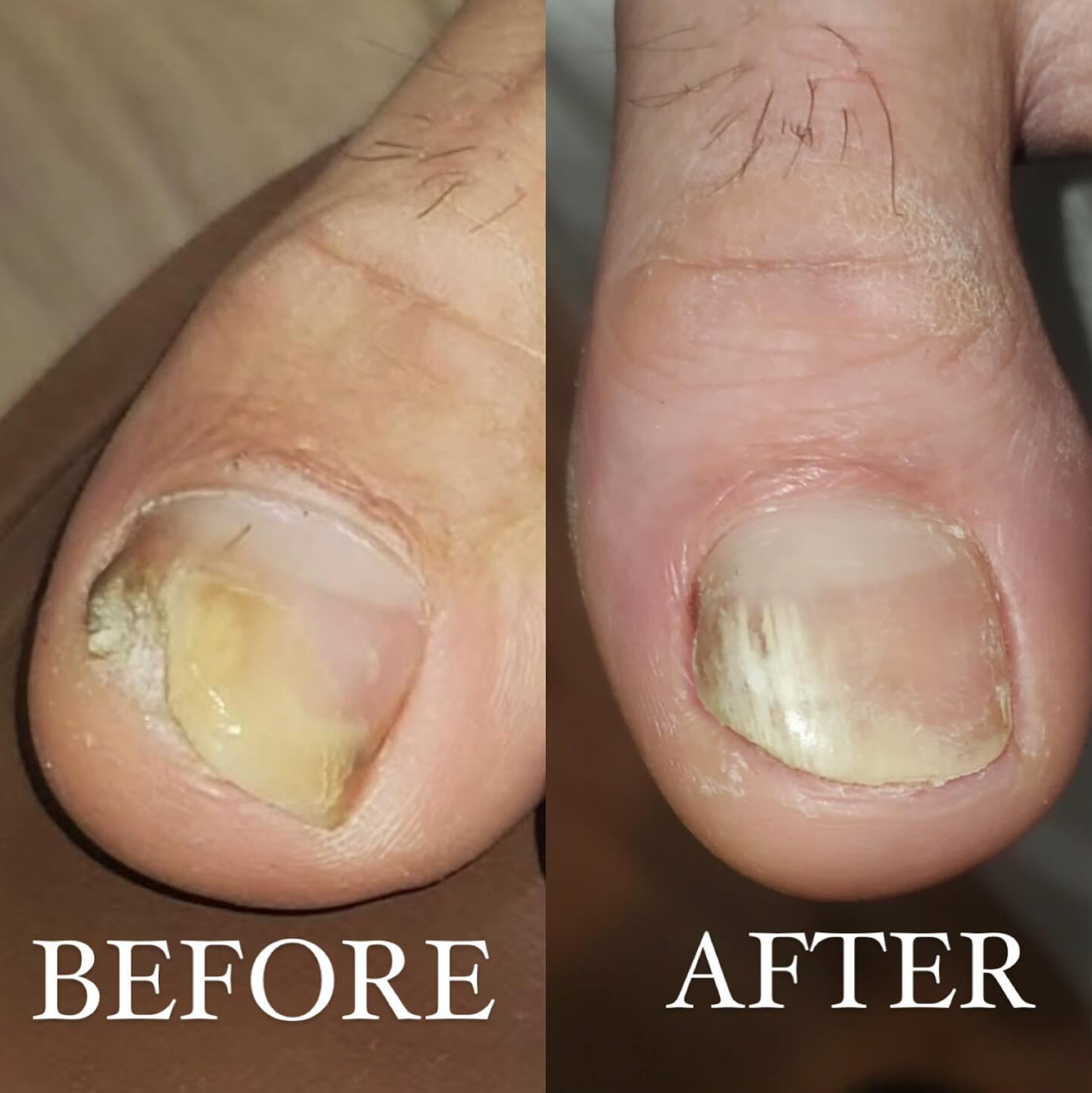 Nail Fungus