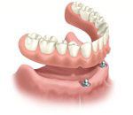 Dentures attached to implants in the lower jaw, with the upper denture visible.