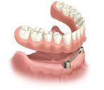Dental partial denture, pink and white, with a metal bar attached to an upper and lower gum model.
