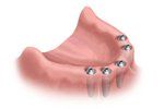 A dental illustration showing a jawbone with several titanium dental implants.
