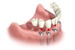 Dental implant procedure: new teeth attached to implants in the lower jaw