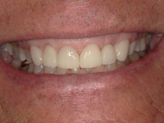 Dr. Michael Yang DDS - crowns