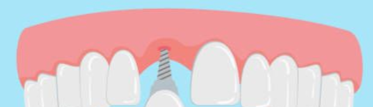 Diagram of a dental implant being installed in the upper jaw with adjacent teeth.