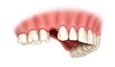 Single Tooth implant