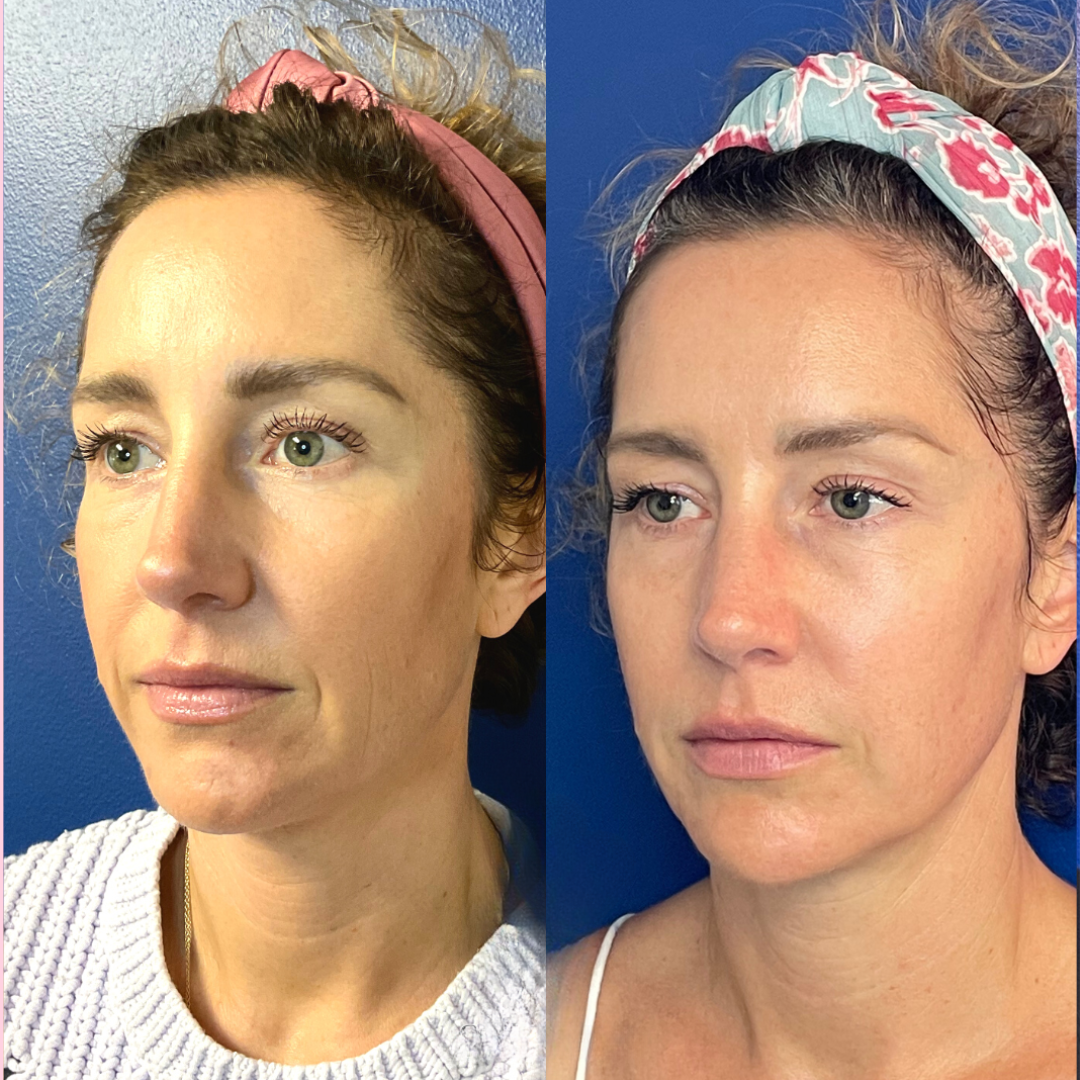 Dermal Filler Treatment