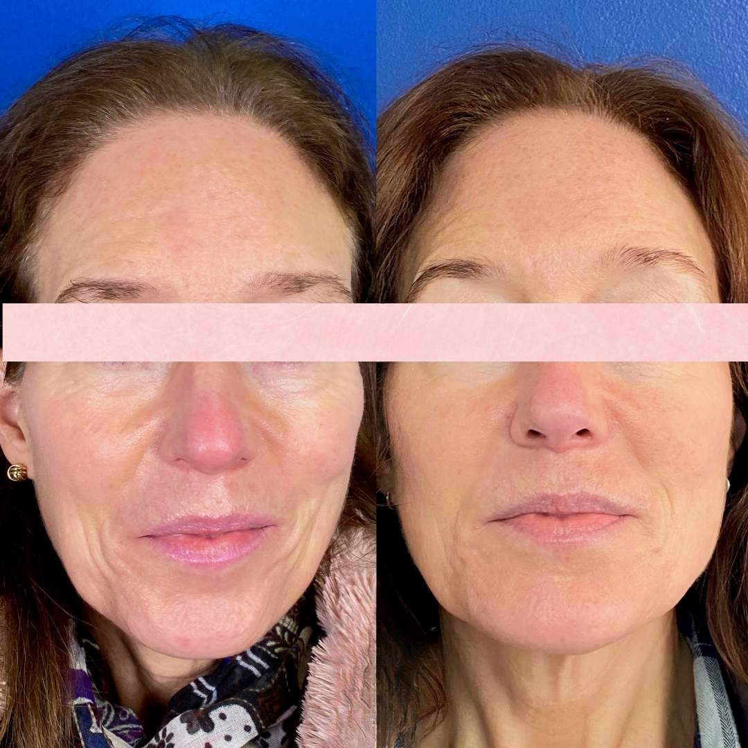 Sculptra before and after of a woman's face