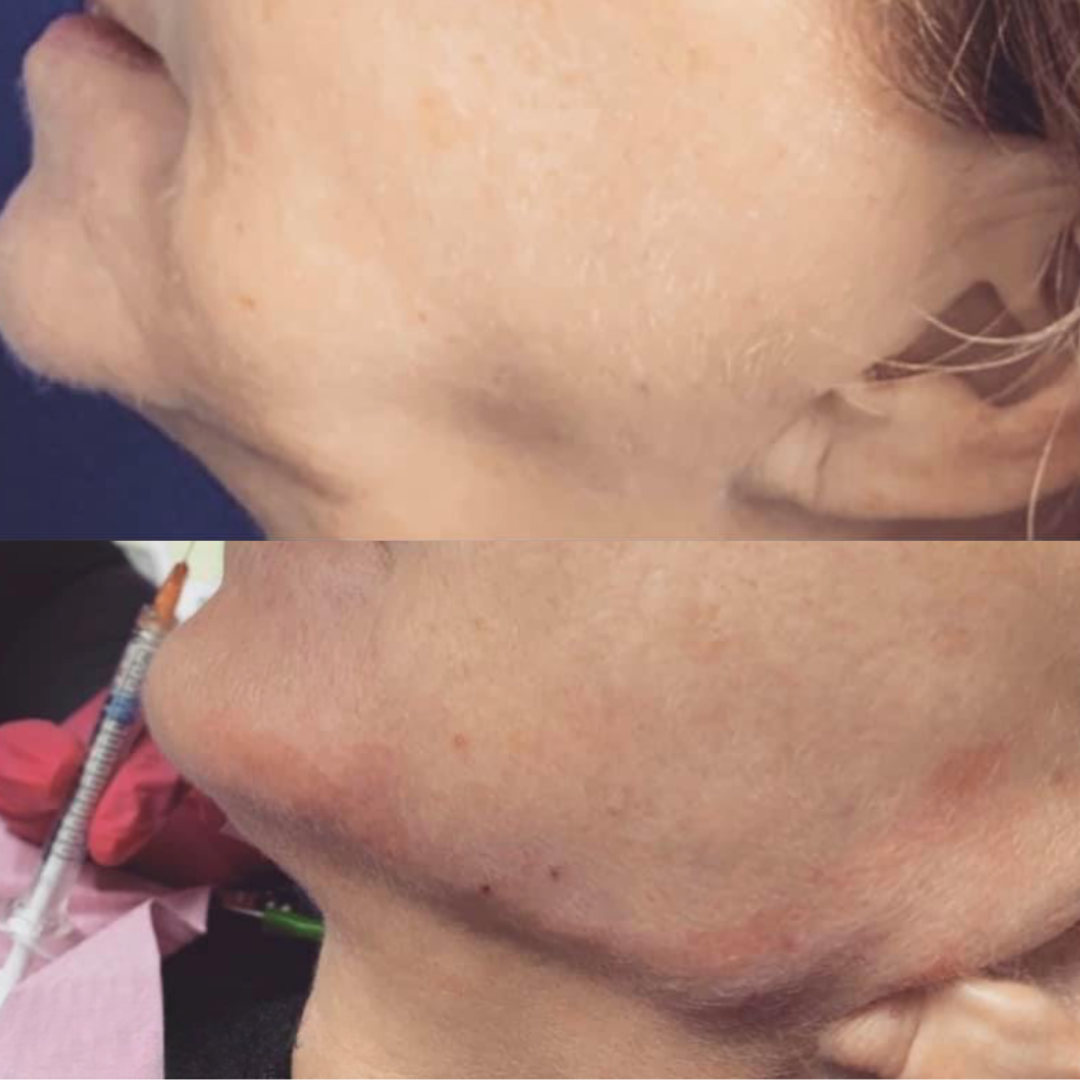 dermal filler before and after image