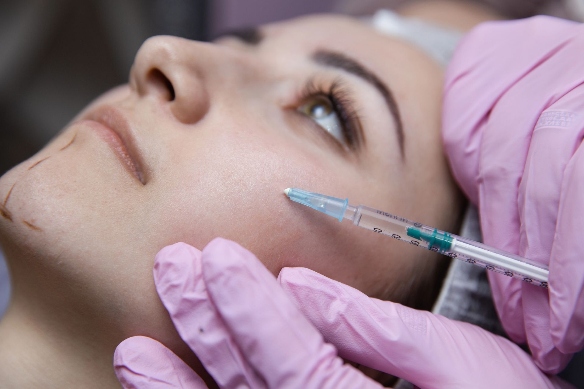 Dermal Filler Treatment