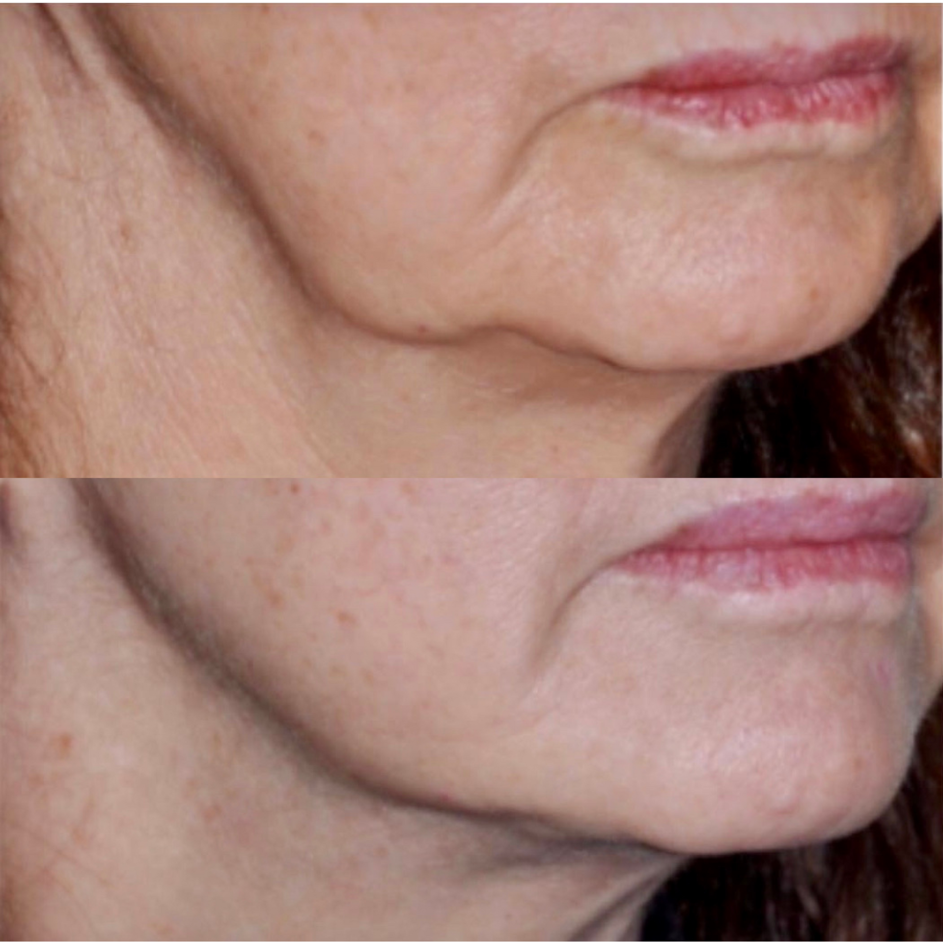Kybella before and after of a woman's jowls
