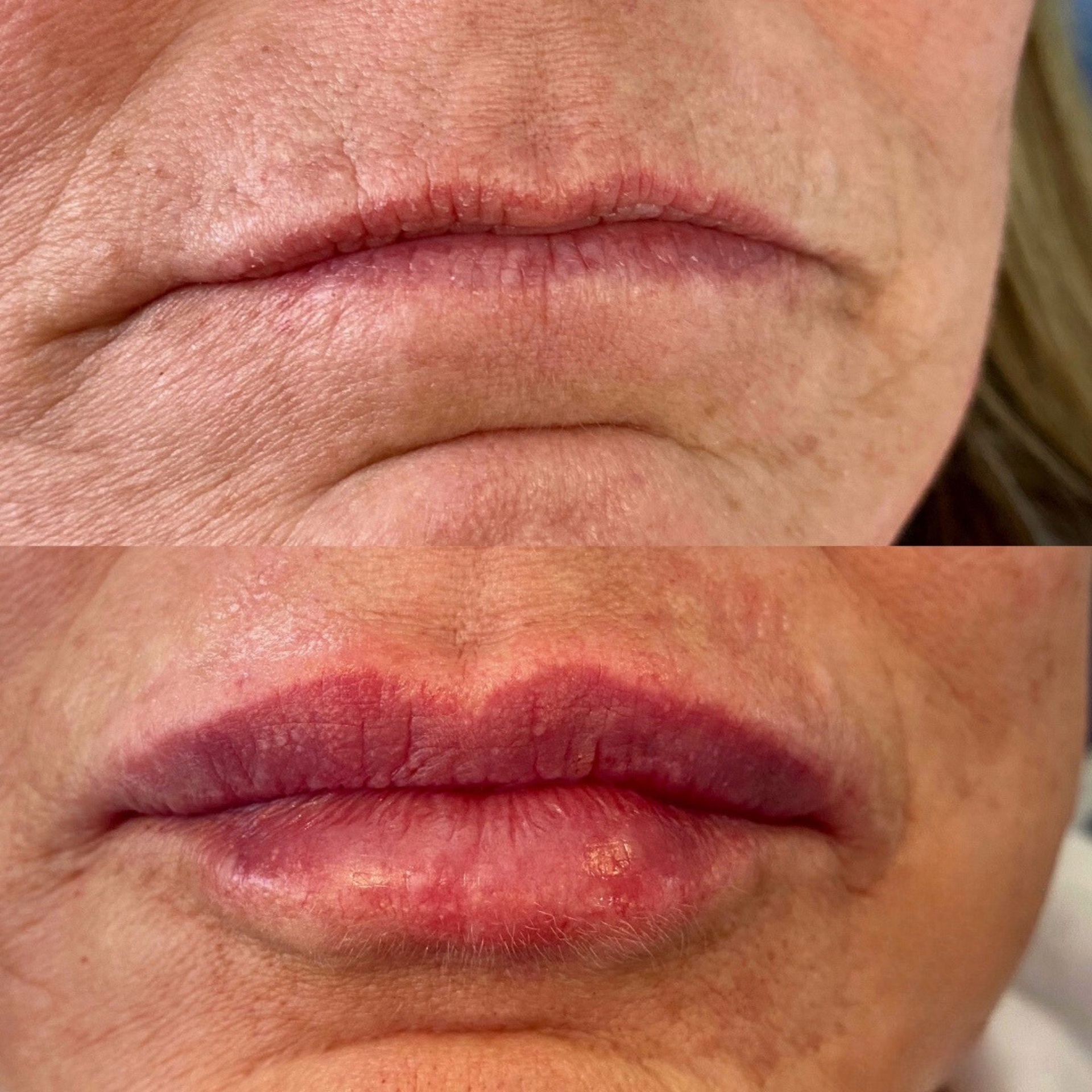 Lip filler before and after image
