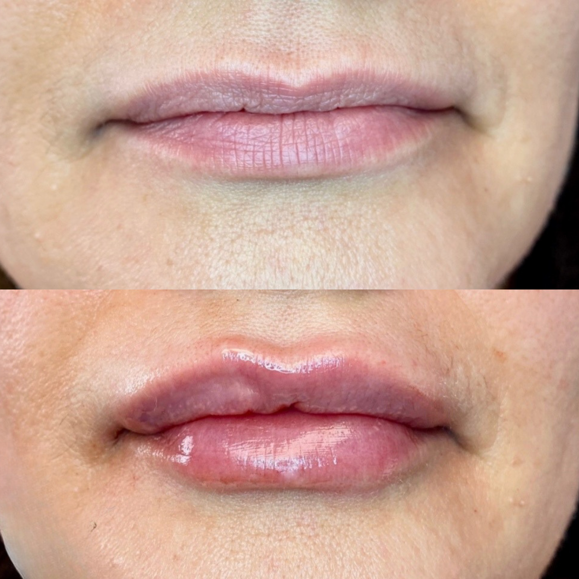 Lip filler before and after image