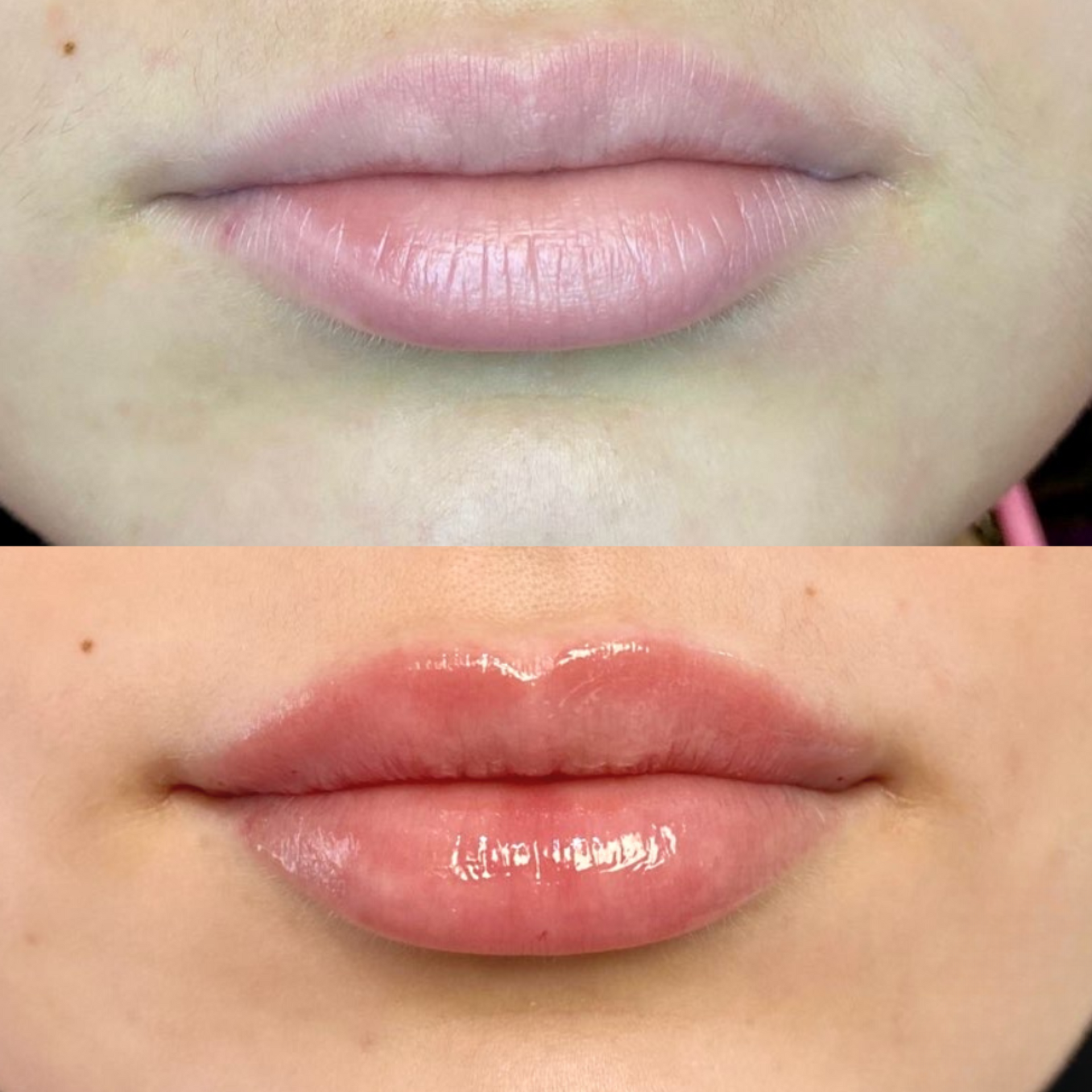 Lip filler before and after image