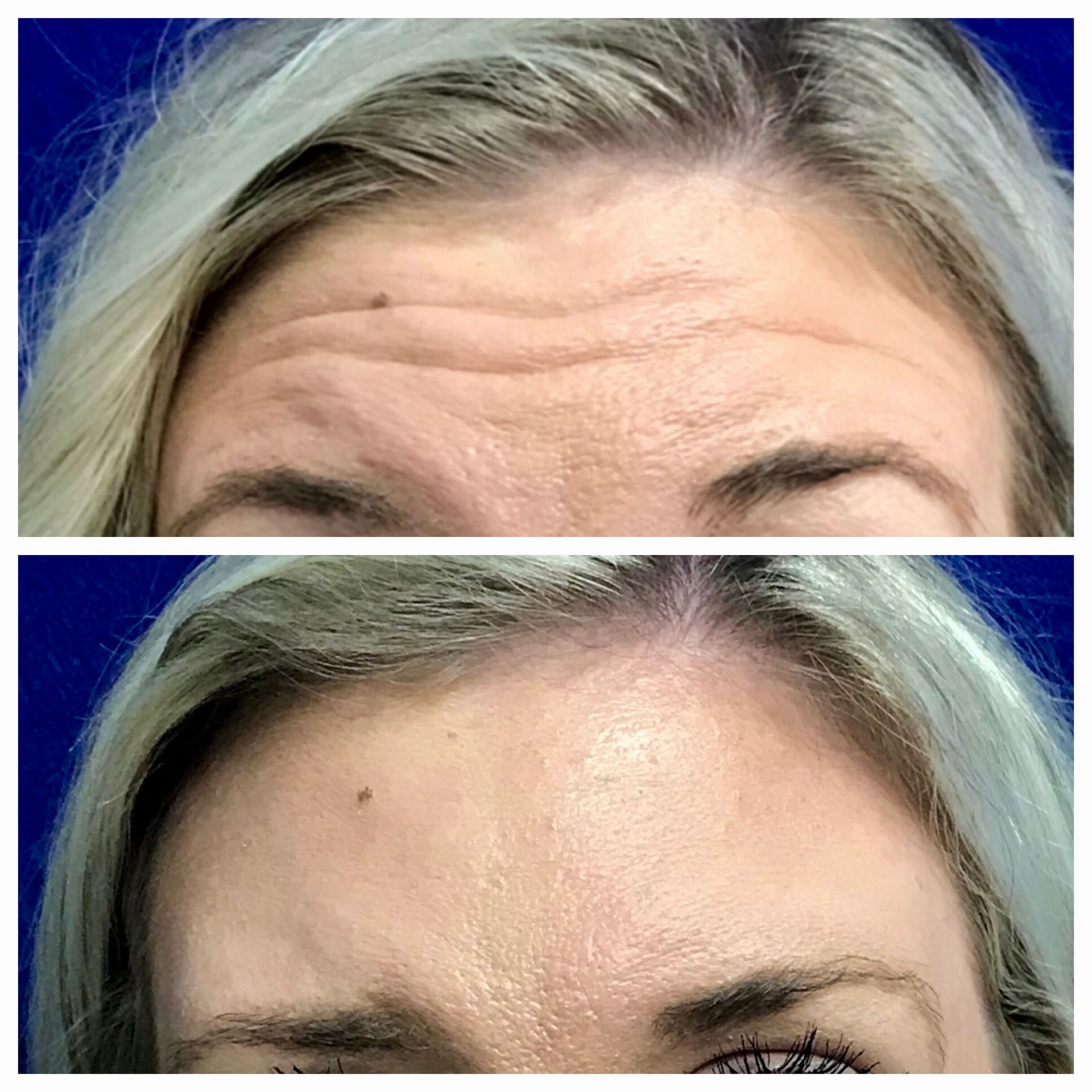 Neurotoxin before and after of a woman's forehead