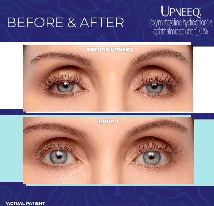 A before and after photo of a woman 's eyes by Upneeq