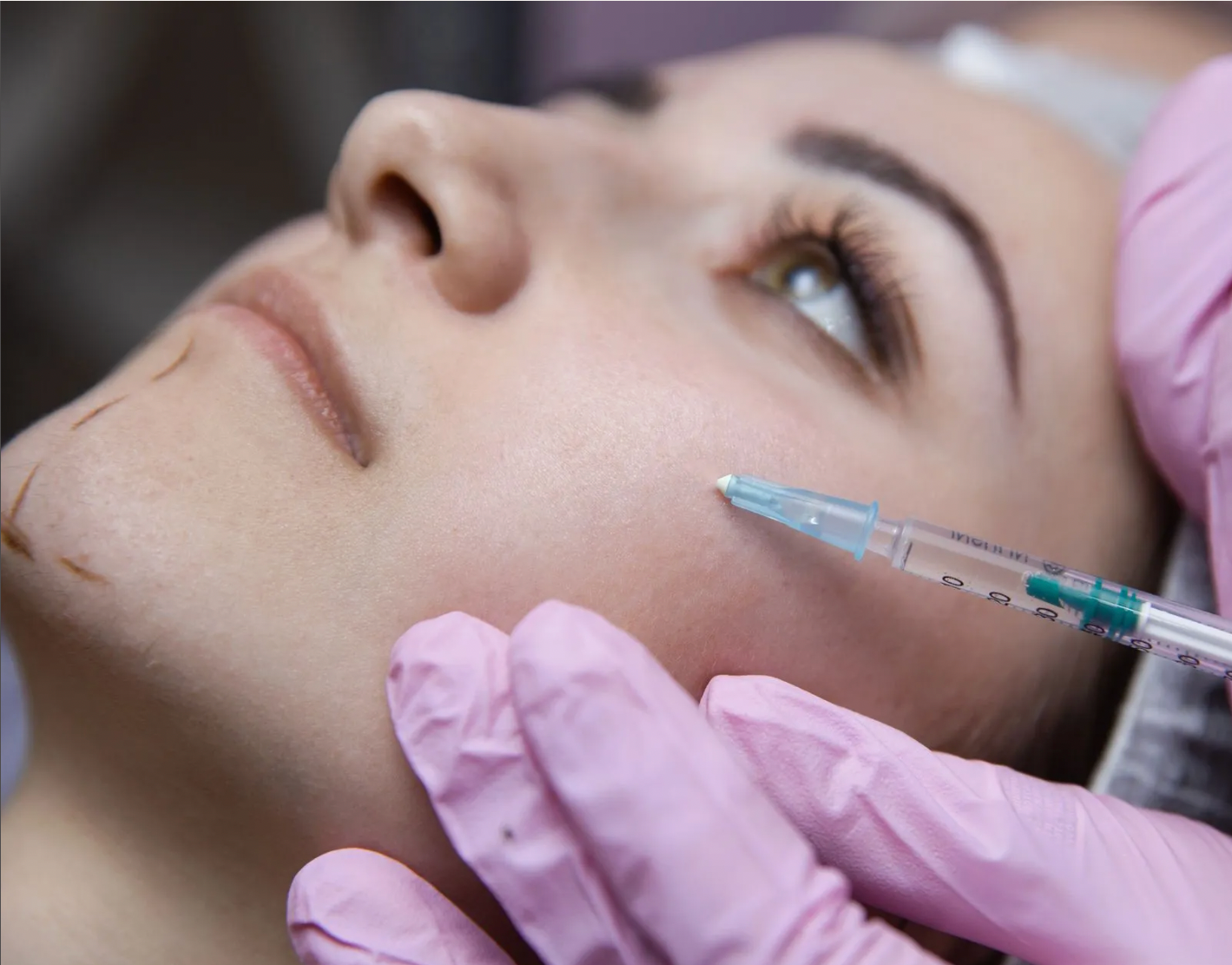 Dermal Filler Treatment