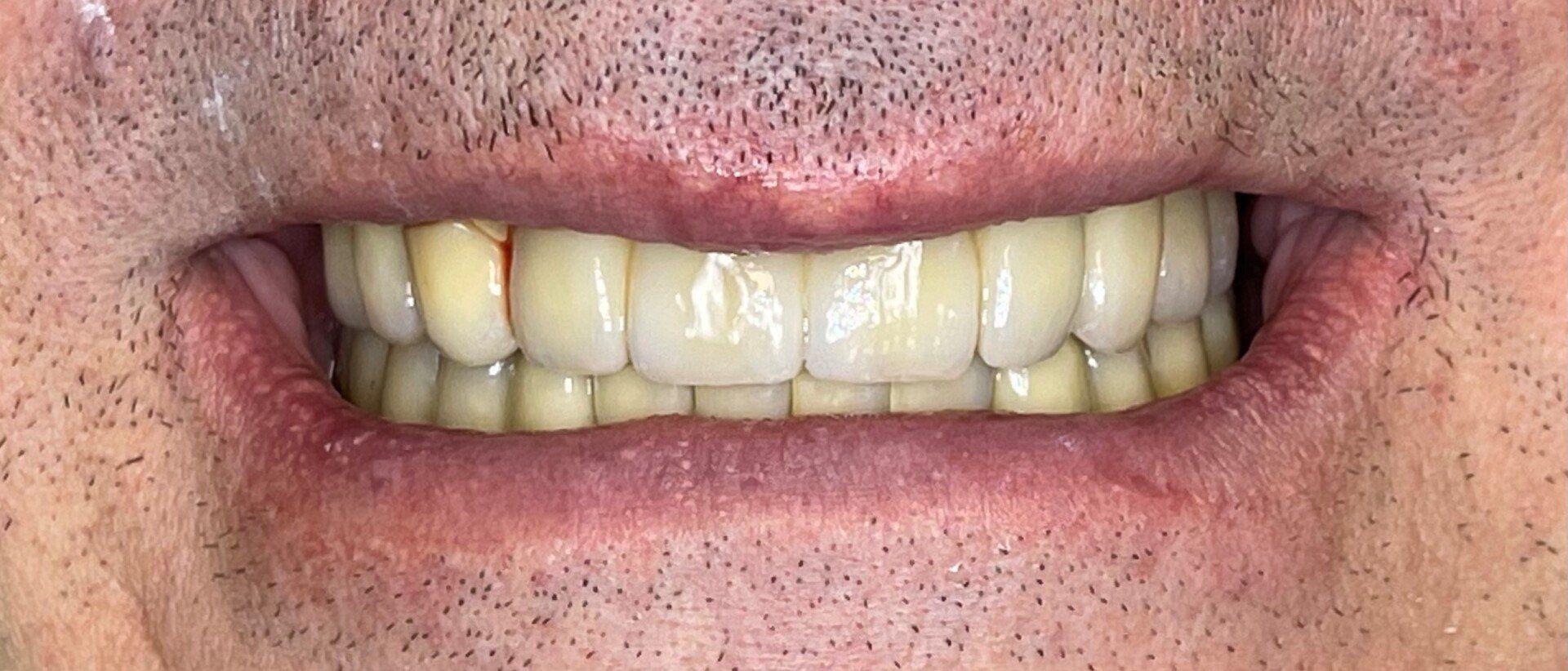 Dentatura dopo