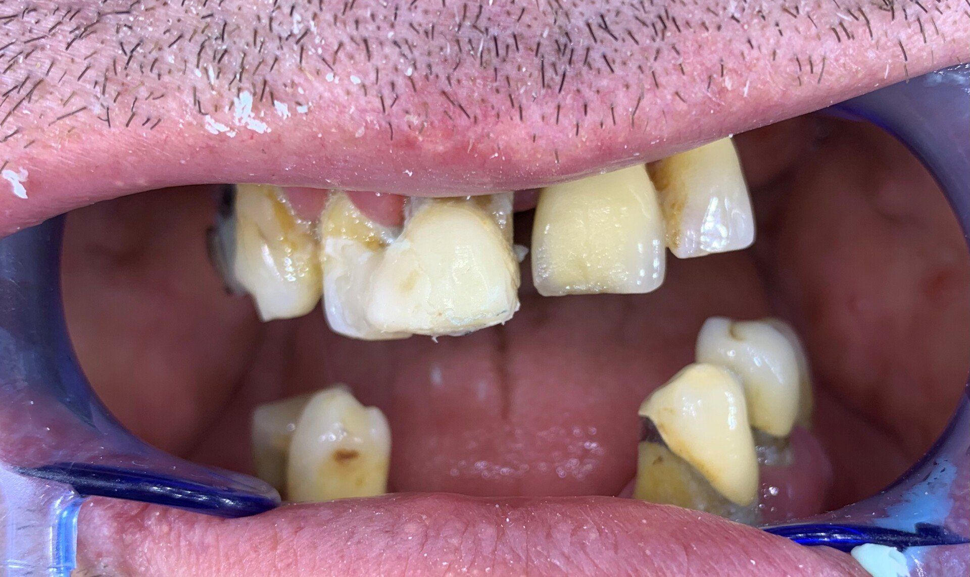 Dentatura prima