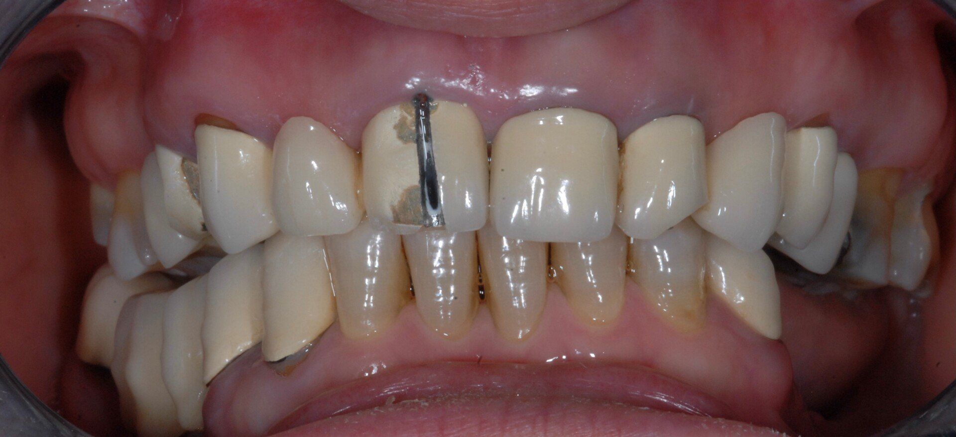 Dentatura prima