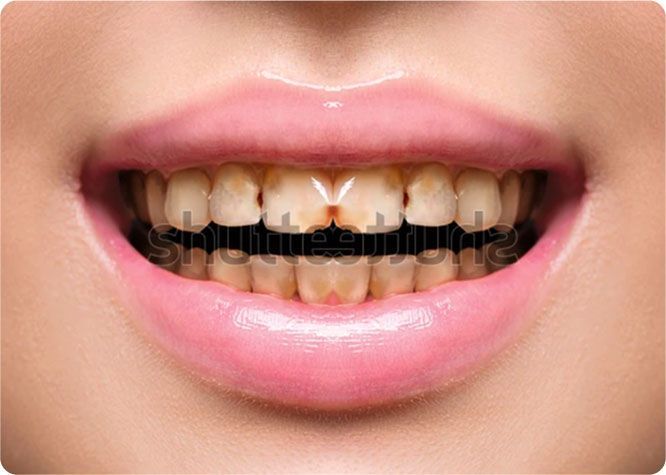Close-up of a person's smiling mouth showing severely stained, discolored teeth and pink lips.