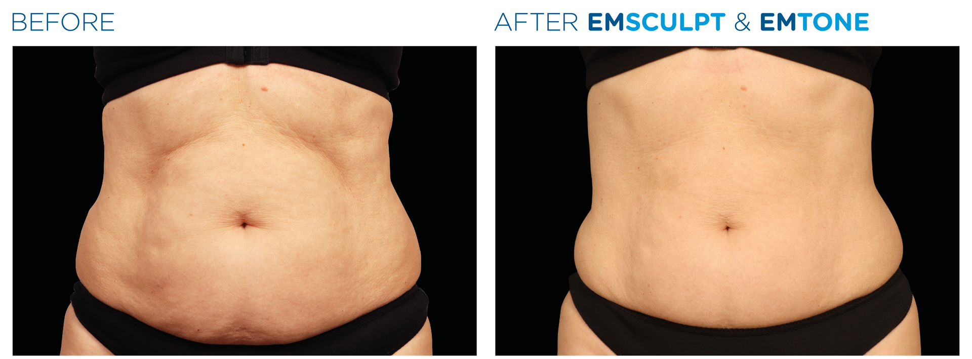 Before-and-after torso photo showing a flatter abdomen after Emsculpt and Emtone treatment