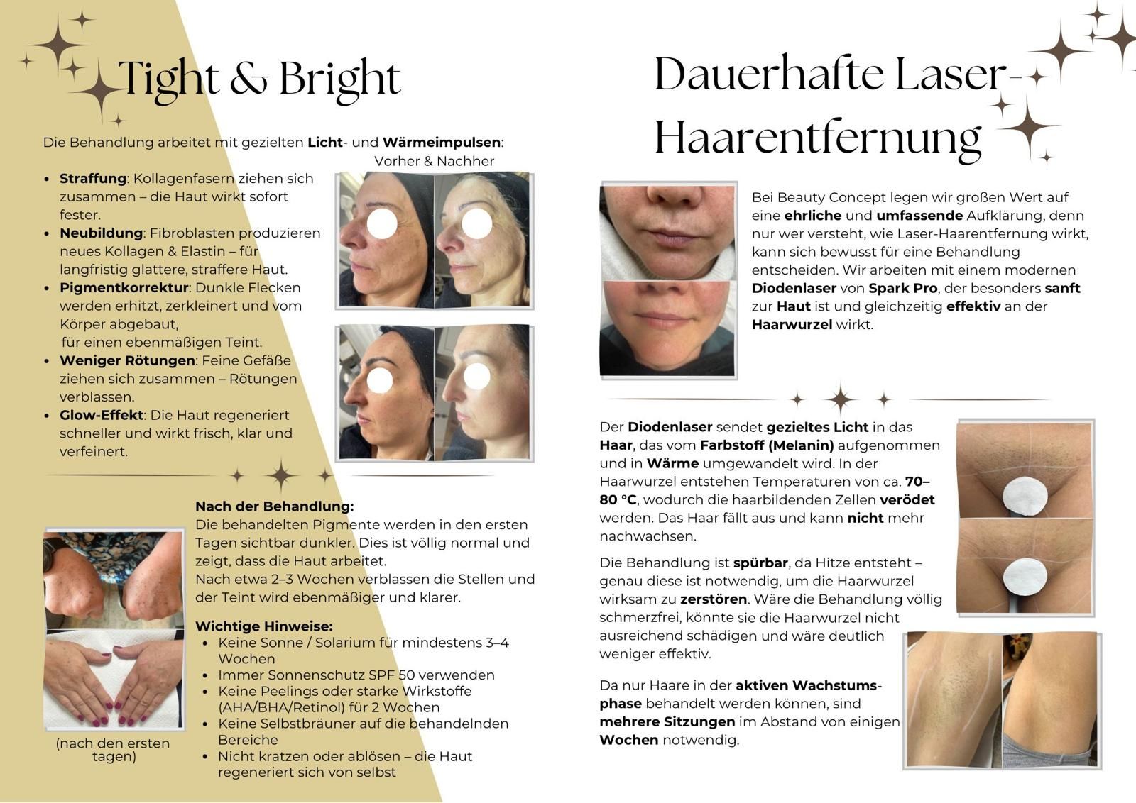 Flyer zur Laserhaarentfernung mit Vorher-Nachher-Bildern, Behandlungsfotos und deutschem Text auf beigem Hintergrund