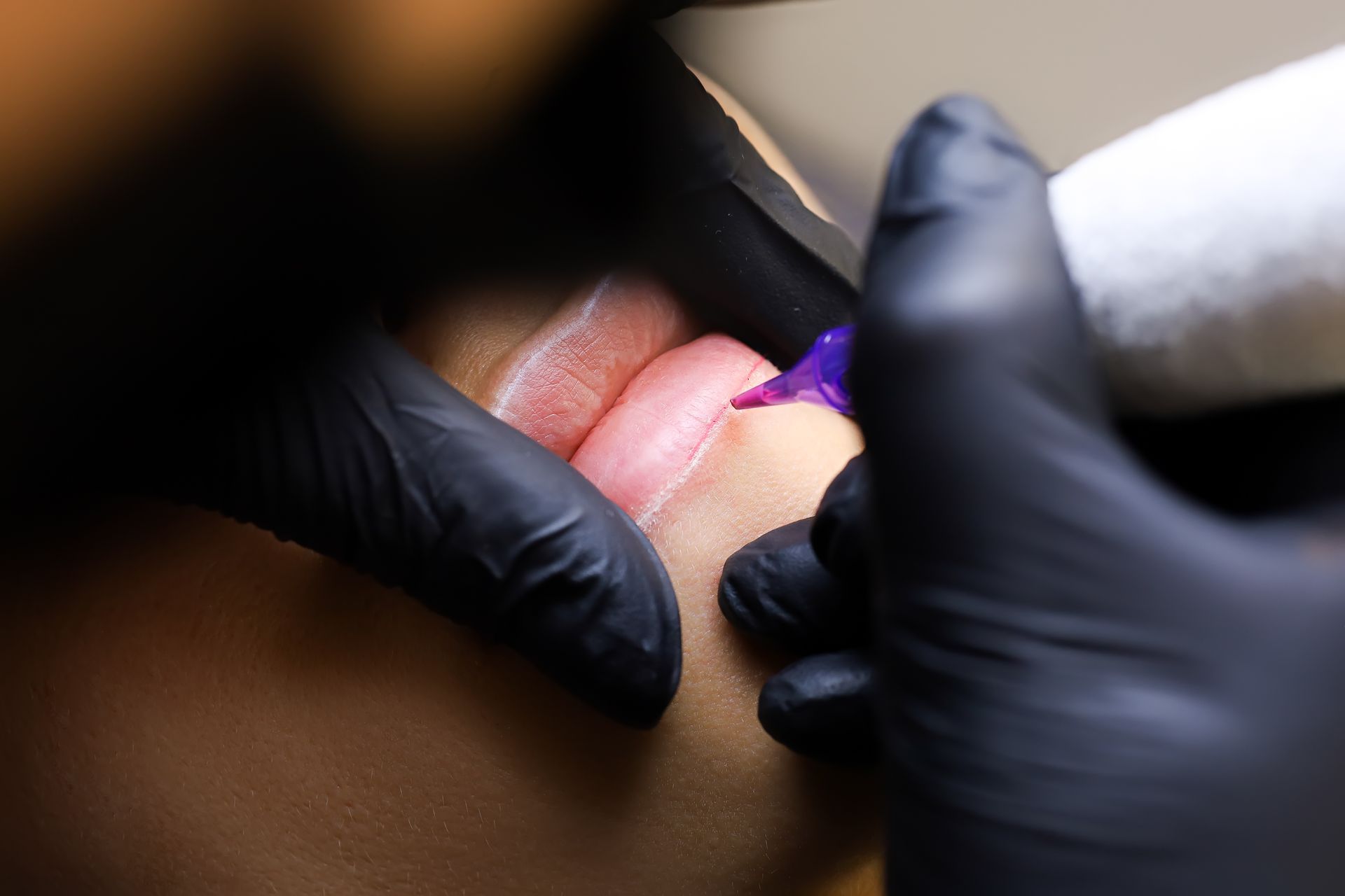 Behandschuhte Hände, die ein violettes Instrument an den Lippen einer Person während einer kosmetischen Behandlung verwenden
