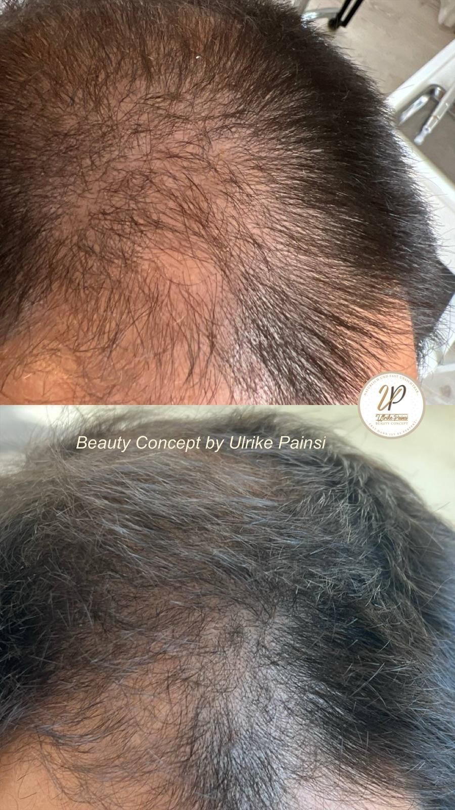 Zwei Nahaufnahmen der Kopfhaut, die die Haarverdünnung vor und nach der Behandlung zeigen.