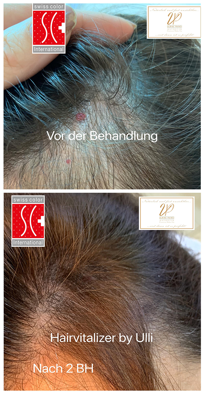Nahaufnahme der Kopfhaut in zwei Bildausschnitten zum Vergleich der Haarverdünnung vor und nach der Behandlung.