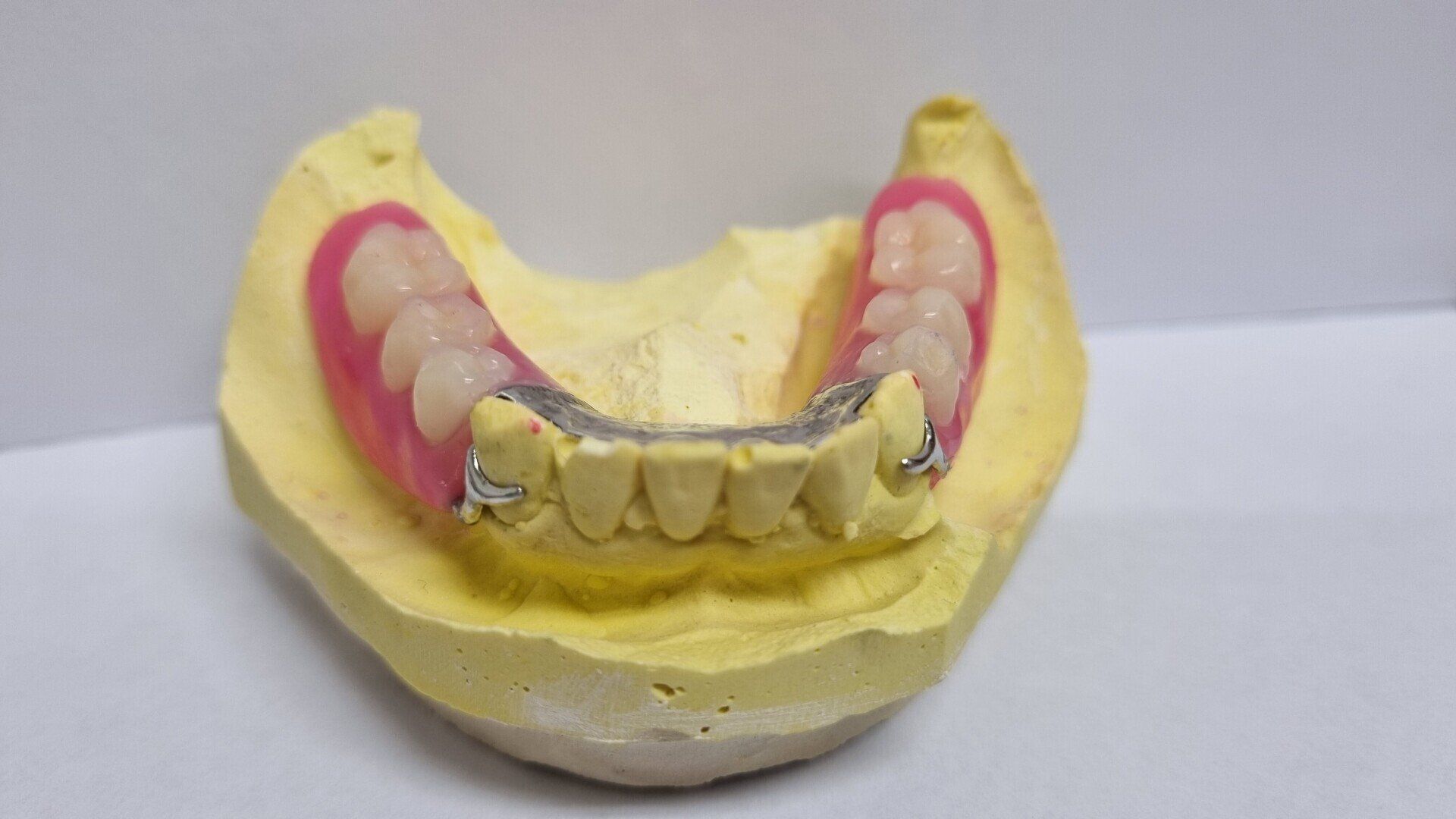 Dental Prosthetic Model — The Denture Care Group Sunshine Coast in Woombye, QLD