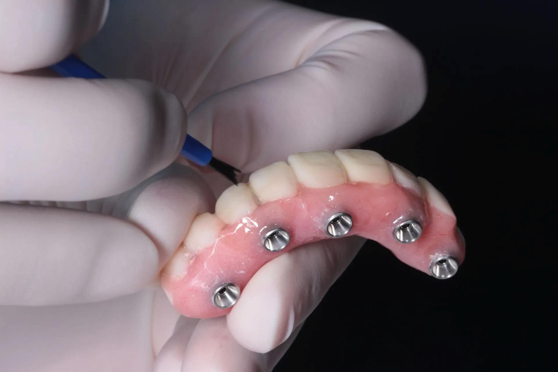 Denture Repairs On The Sunshine Coast For Implant-Supported Denture Maintenance