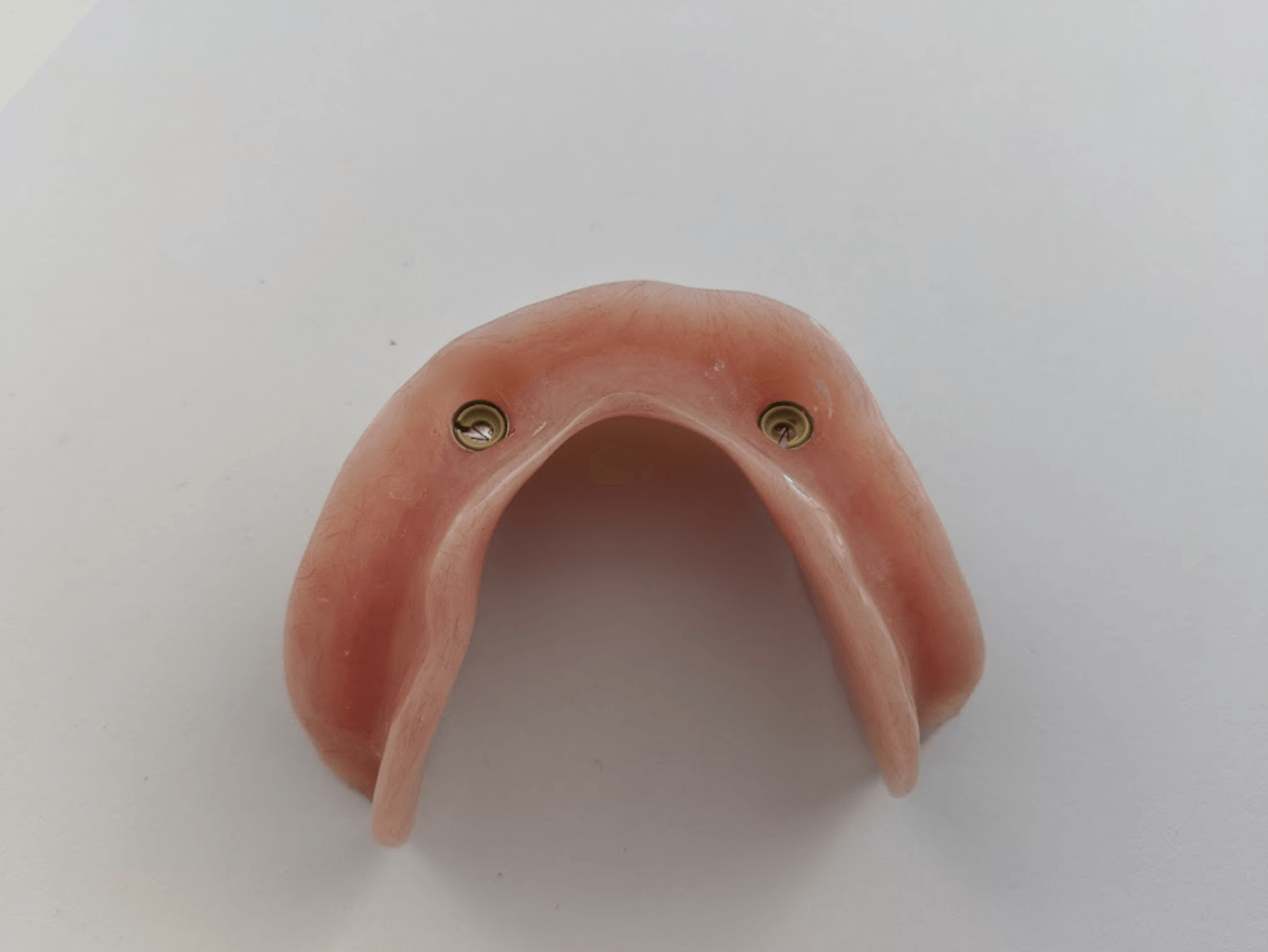 Dental Implant Illustration — The Denture Care Group Sunshine Coast in Caloundra, QLD