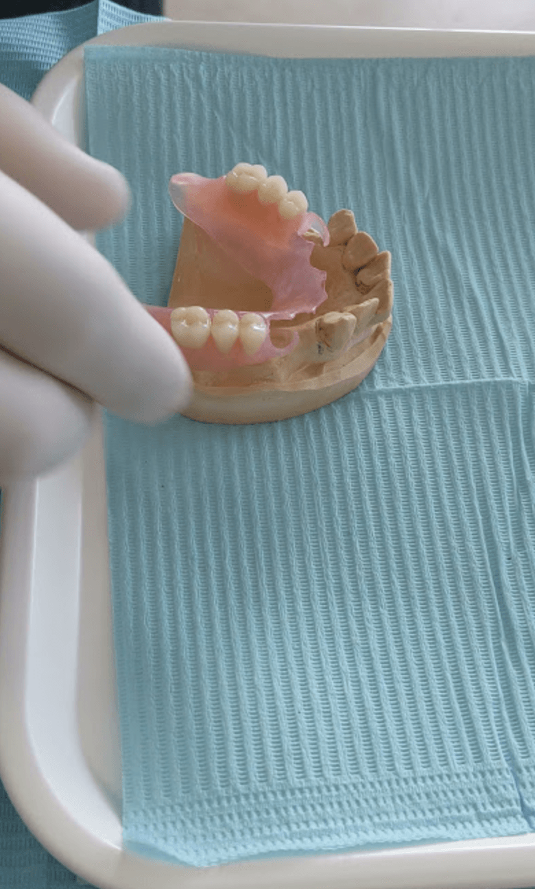 Dental Rehabilitation With Removable Partial Denture — The Denture Care Group Sunshine Coast in Woombye, QLD