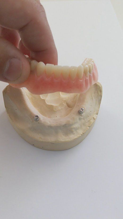 Dental Implant Diagram — The Denture Care Group Sunshine Coast in Caloundra, QLD