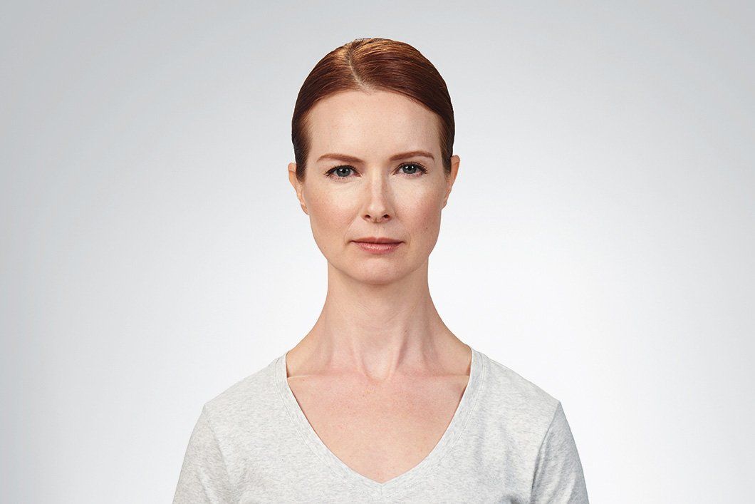 botox 7day after