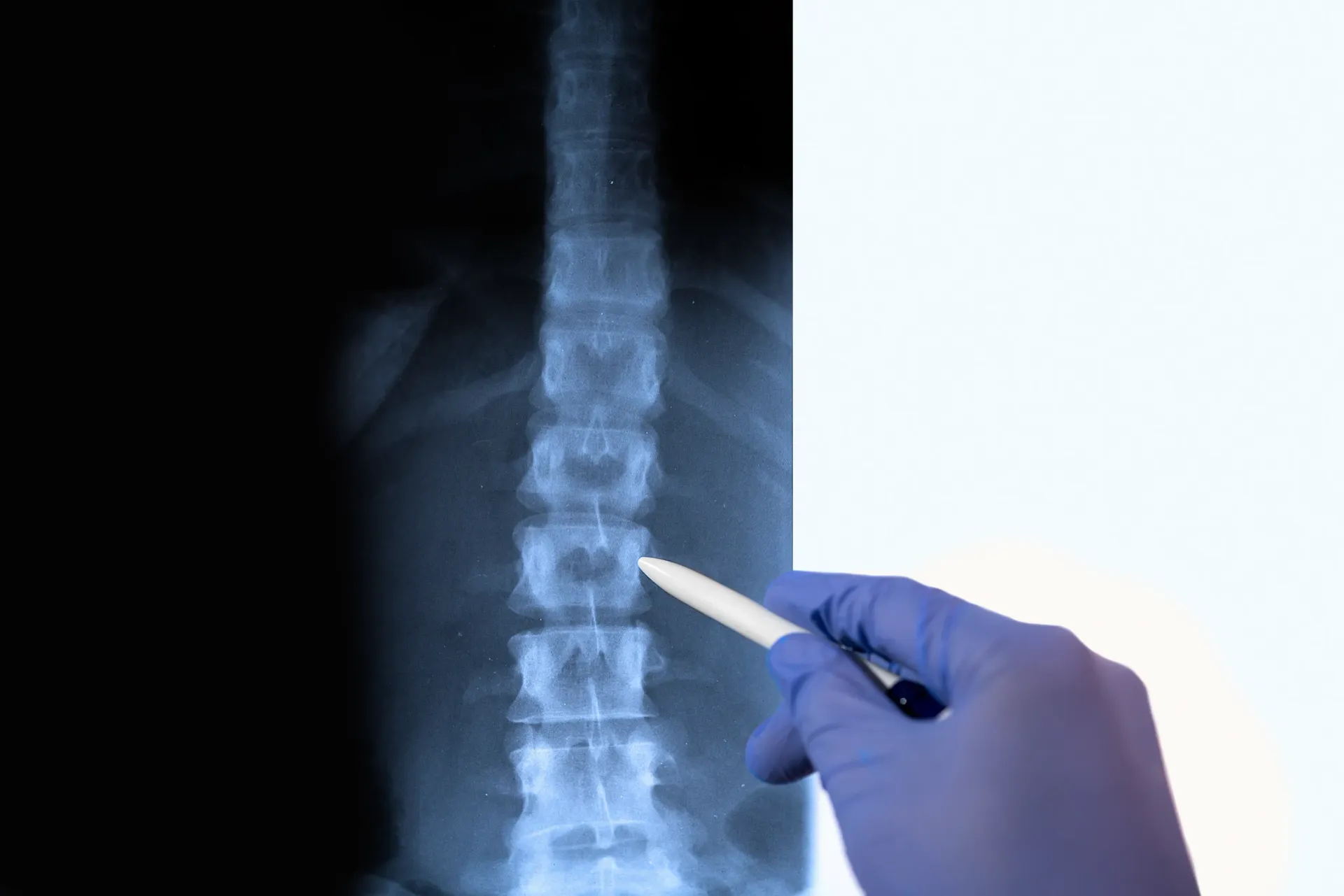 X-ray of spine with a gloved hand pointing at the vertebrae — Spinal Decompression Sunshine Coast In Mooloolaba, QLD