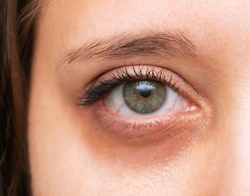Close-Up of A Person's Eye with Dark Circles Under the Eye — Beauty In Profile In Salamander Bay, NSW
