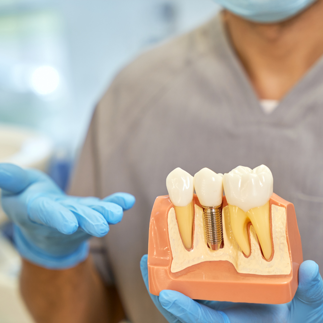 Model of dental implants to show what it looks like