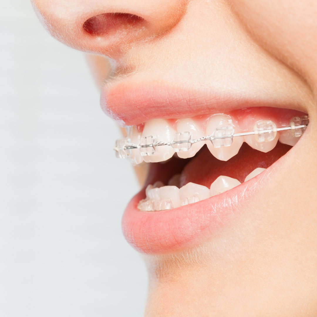 Clear fixed braces on patient