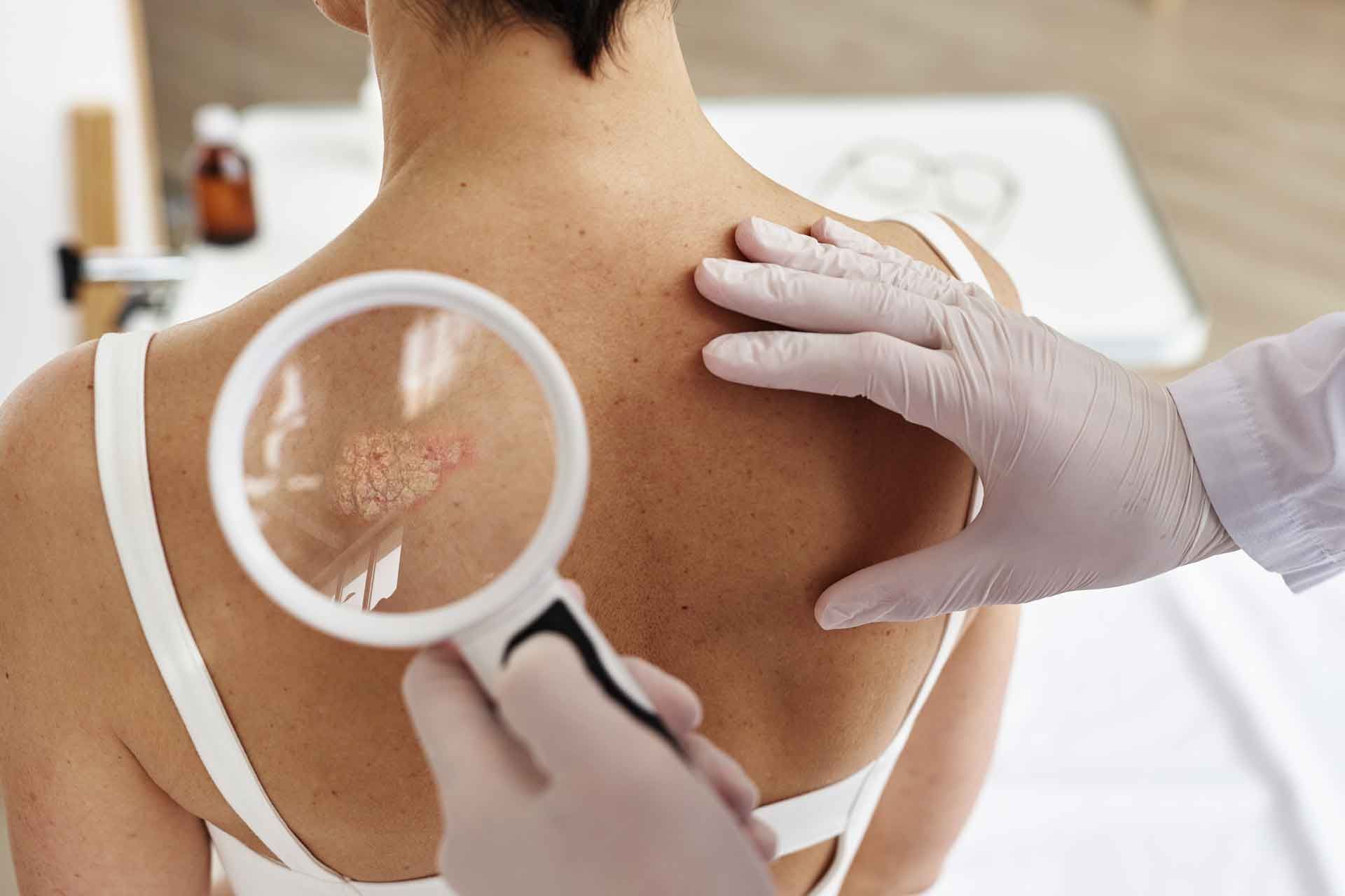 Doctor Examining a Mole on A Patient Back with A Magnifying Glass — Rainbow Beach General Practice in Rainbow Beach, QLD